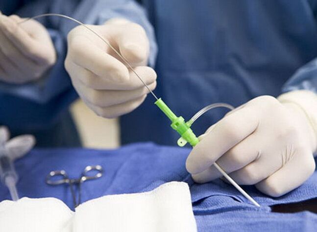 Αφαίρεση ραδιοσυχνοτήτων