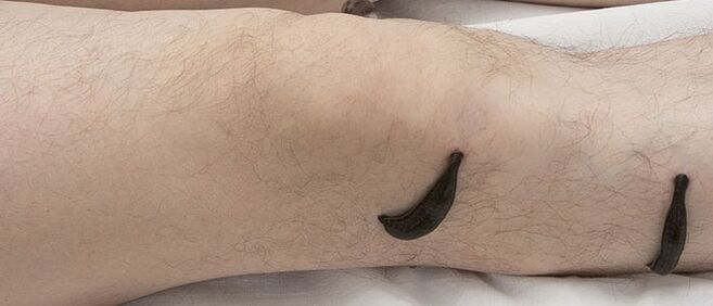 Χιρουδοθεραπεία