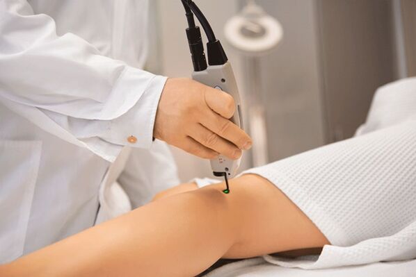 Πήξη λέιζερ των φλεβών των κάτω άκρων